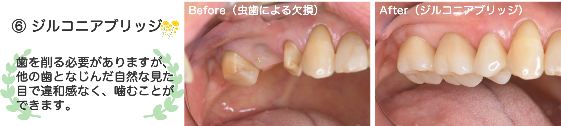 ジルコニアブリッジ