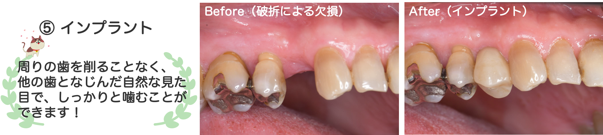 インプラント