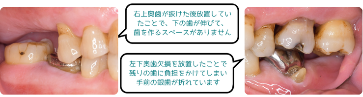 歯が抜けた場所、放置していませんか？
