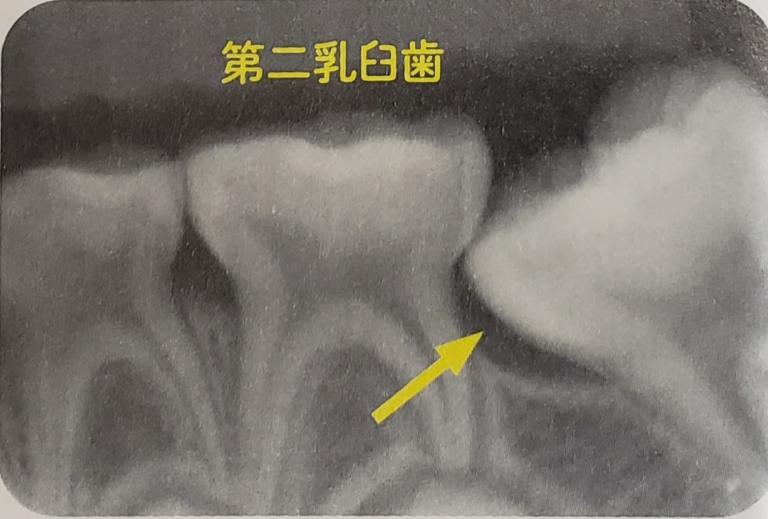  3.第一大臼歯(６歳臼歯)がまっすぐ出てきていない
