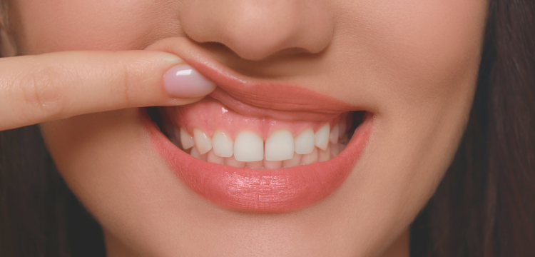 ガミースマイル