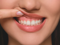 ガミースマイル