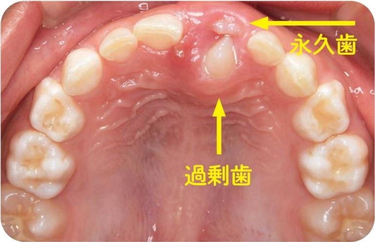  4.永久歯の過剰歯が存在している。　　　　　　　　
