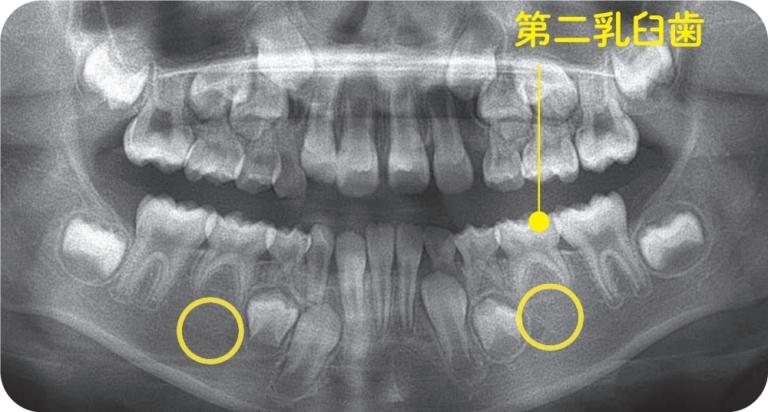  5.先天的に永久歯の数が少ない。