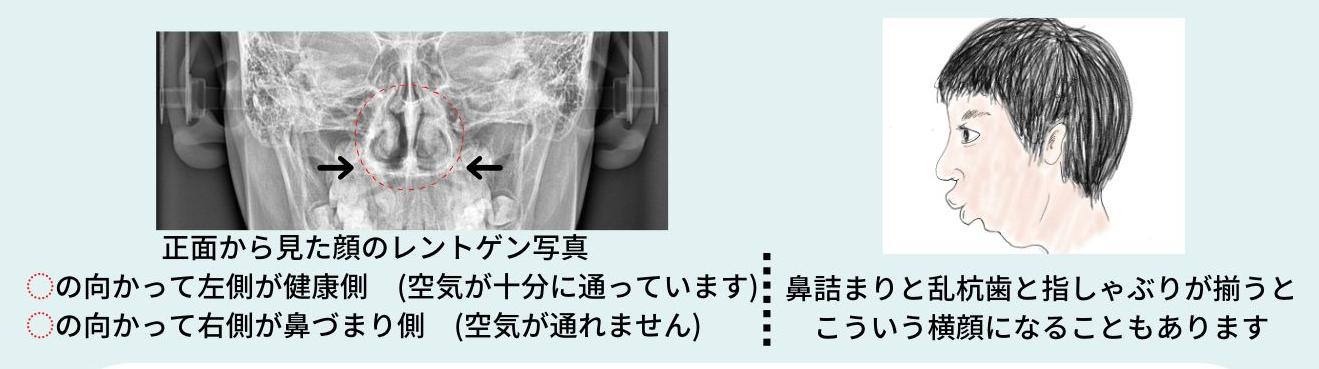 慢性の鼻炎や鼻閉がないかチェックしてみましょう！


