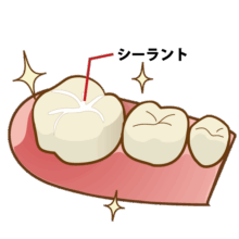 シーラント