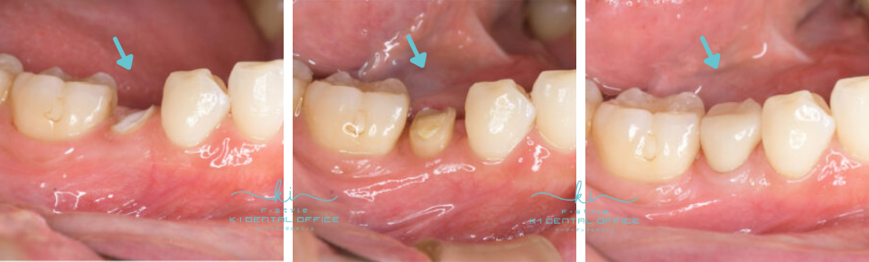 できるだけ歯を残す