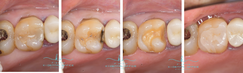 ジルコニアインレー