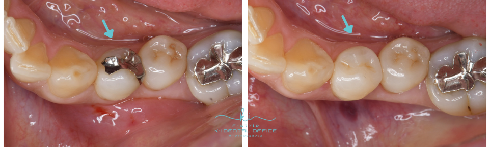 セラミックインレー